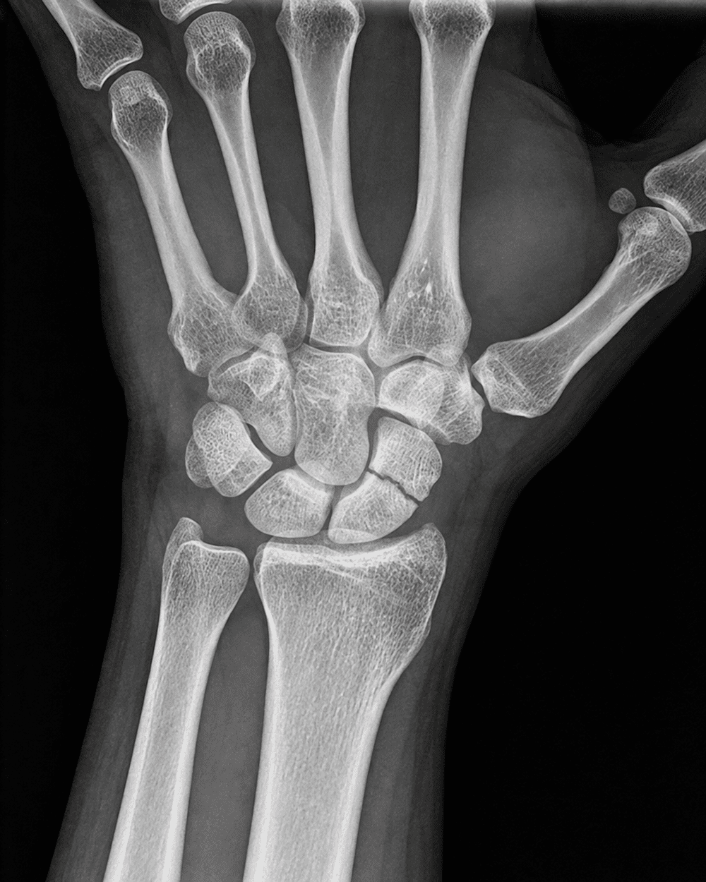 Imagen ilustrativa de una radiografía de muñeca con fractura de escafoides