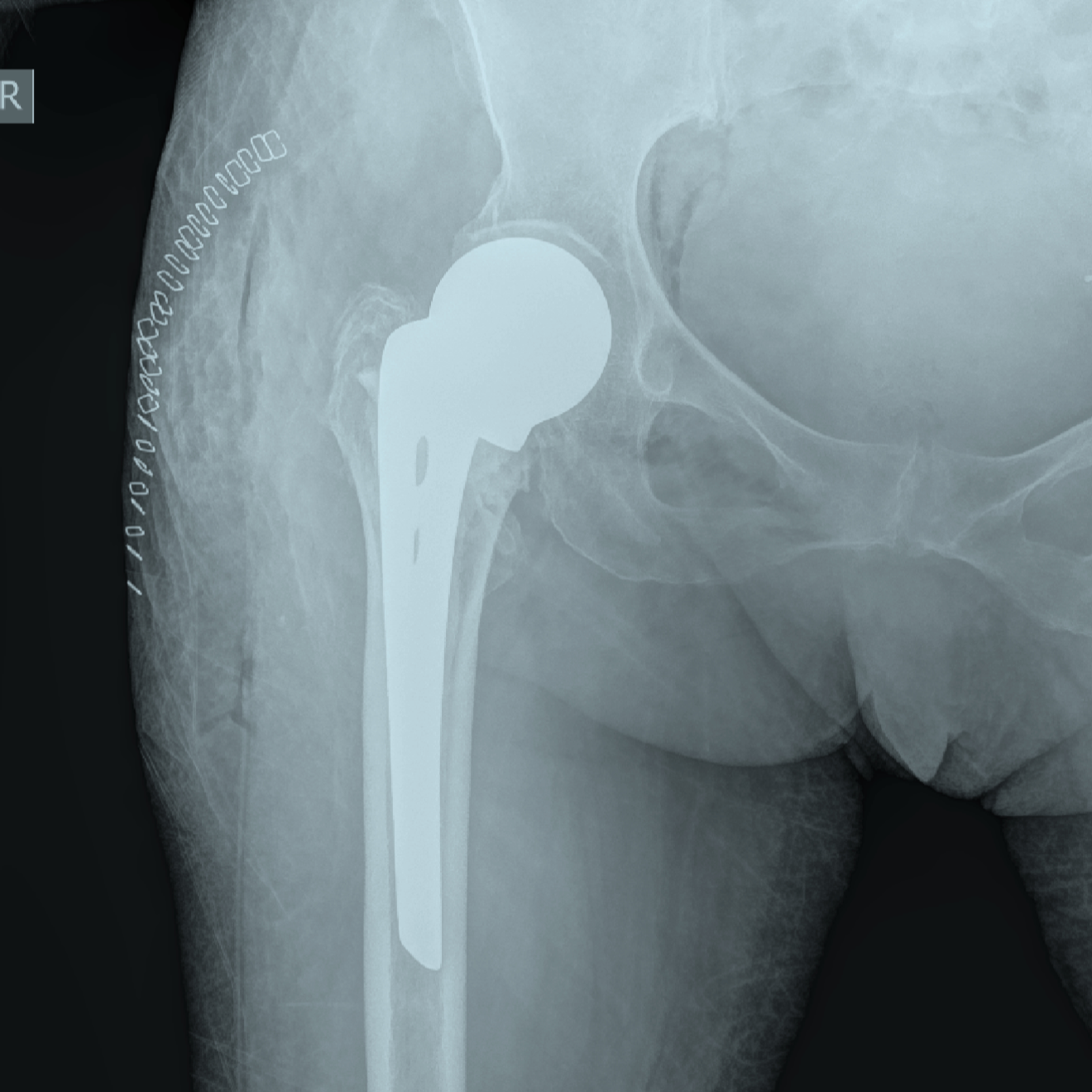 Radiografía de cadera con prótesis de reemplazo de cadera