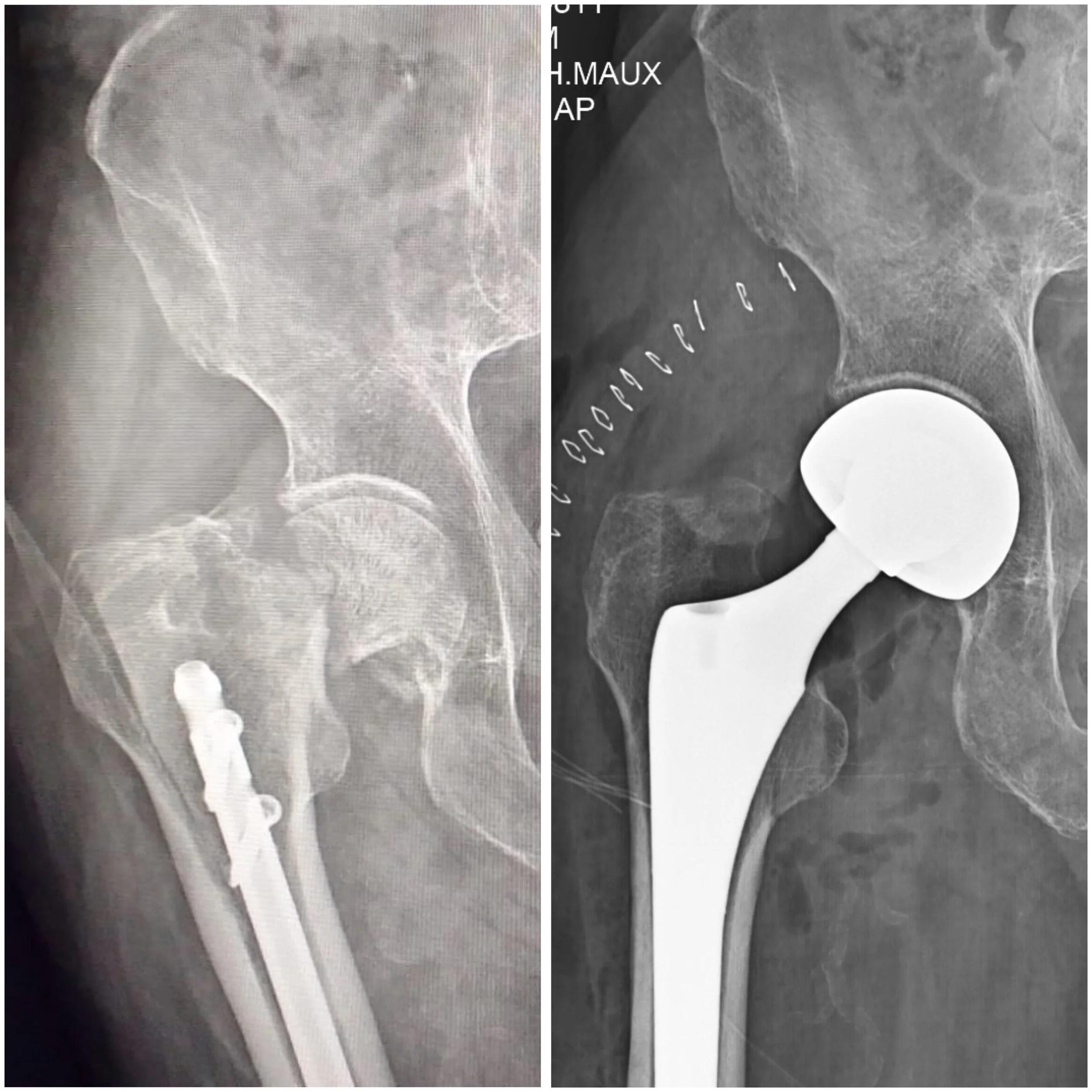 Imágenes de radiografías de pelvis y cadera, una en escala de gris claro y otra en escala de gris oscuro con letras y números médicos.