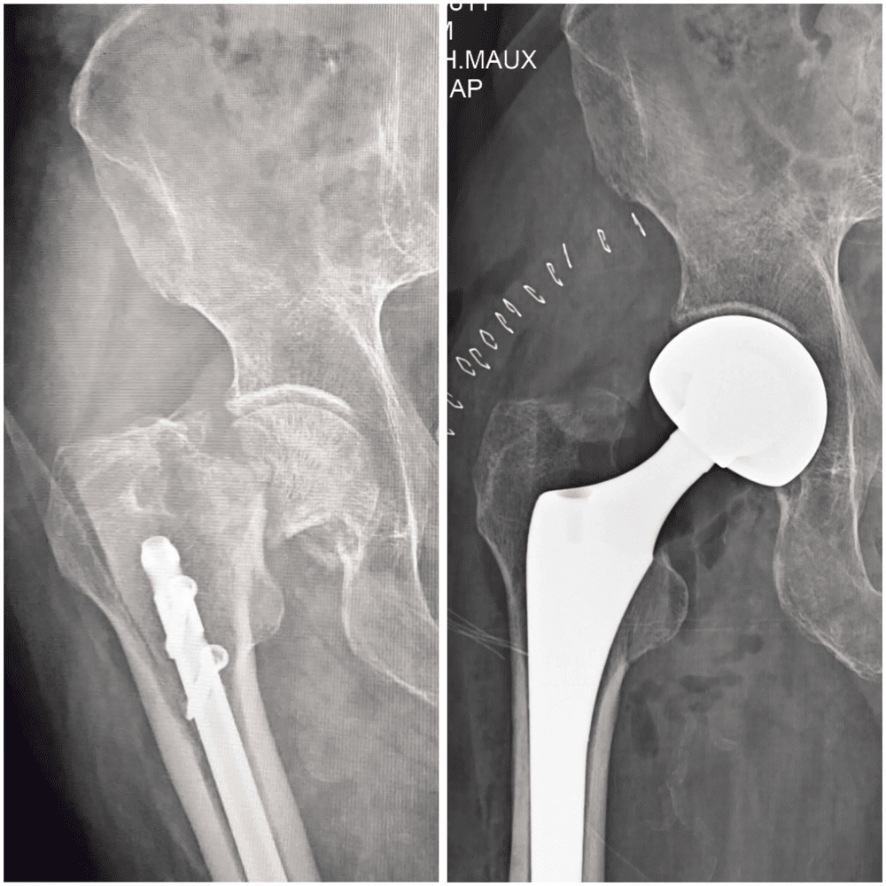 Radiografías de cadera: material de fijación en el fémur y una prótesis de cadera