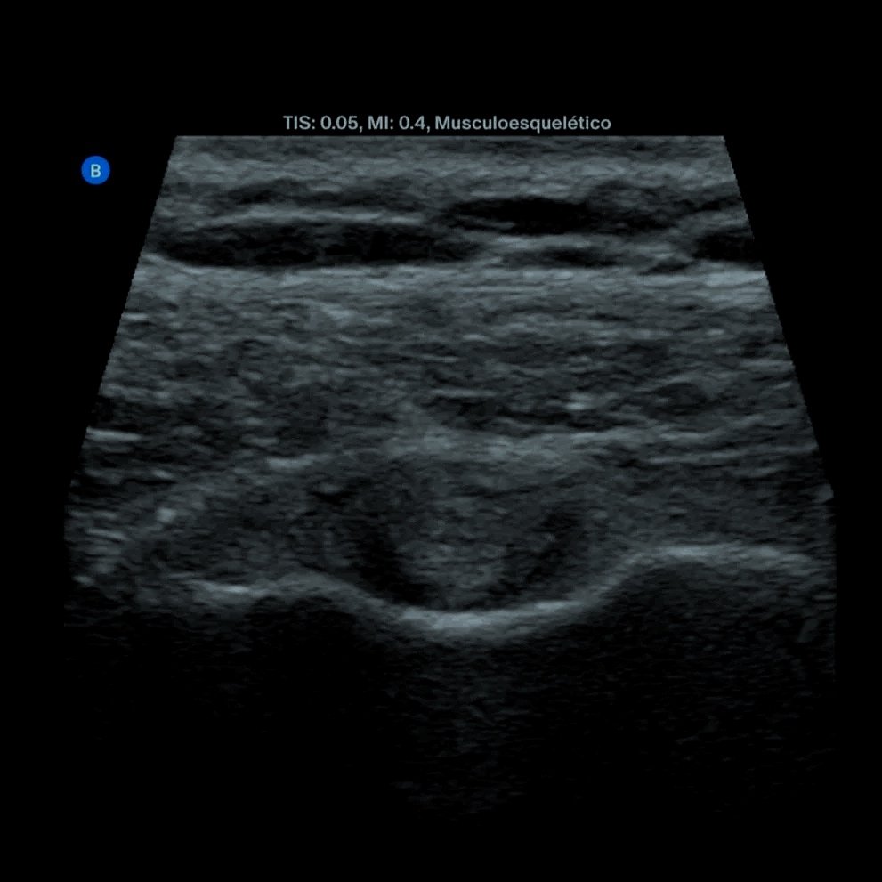 Imagen de una ecografía médica en escala de grises, mostrando estructuras internas del cuerpo humano.