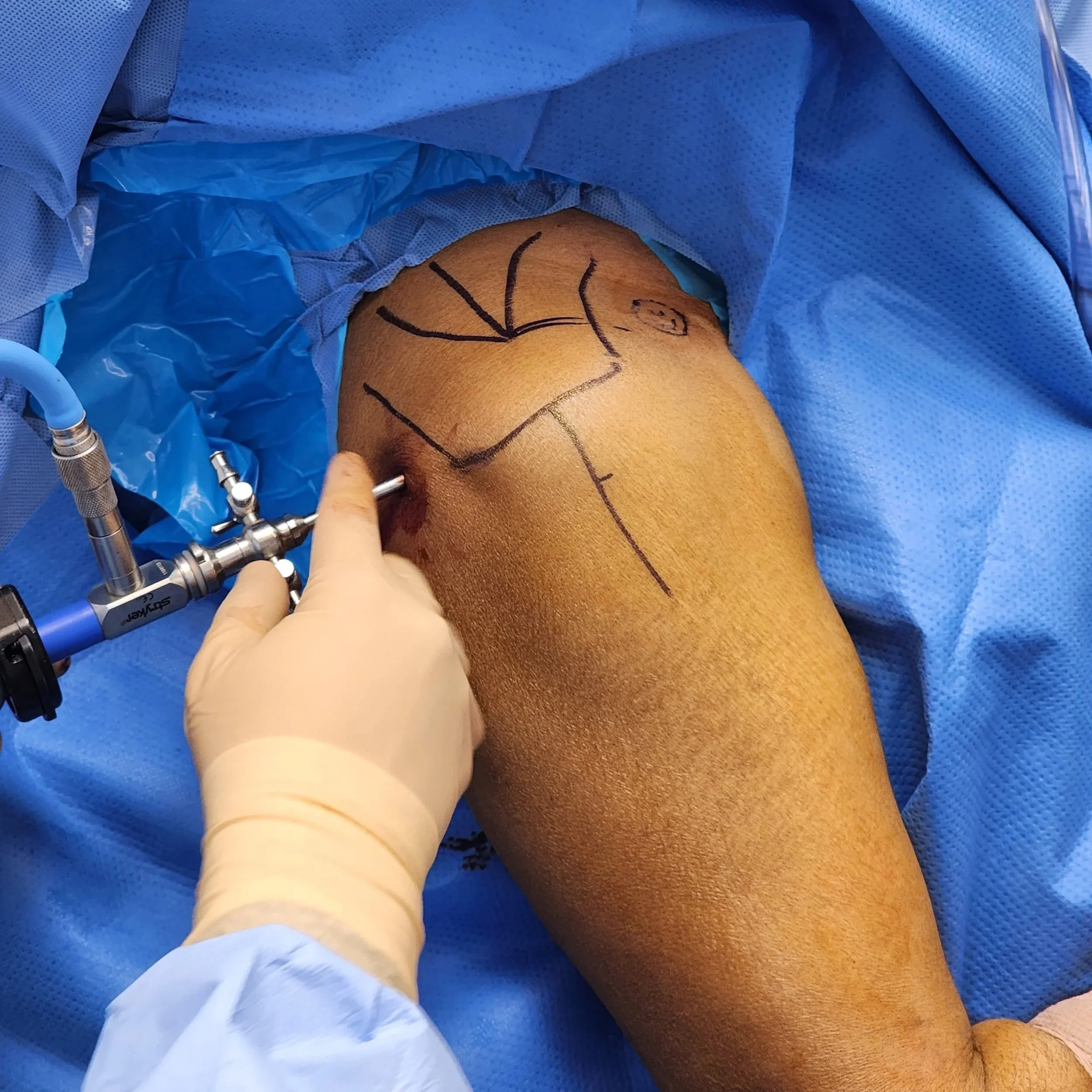 Procedimiento quirúrgico en una rodilla con marca negra hecha con un marcador, rodeada de tela azul quirúrgica y equipos médicos.