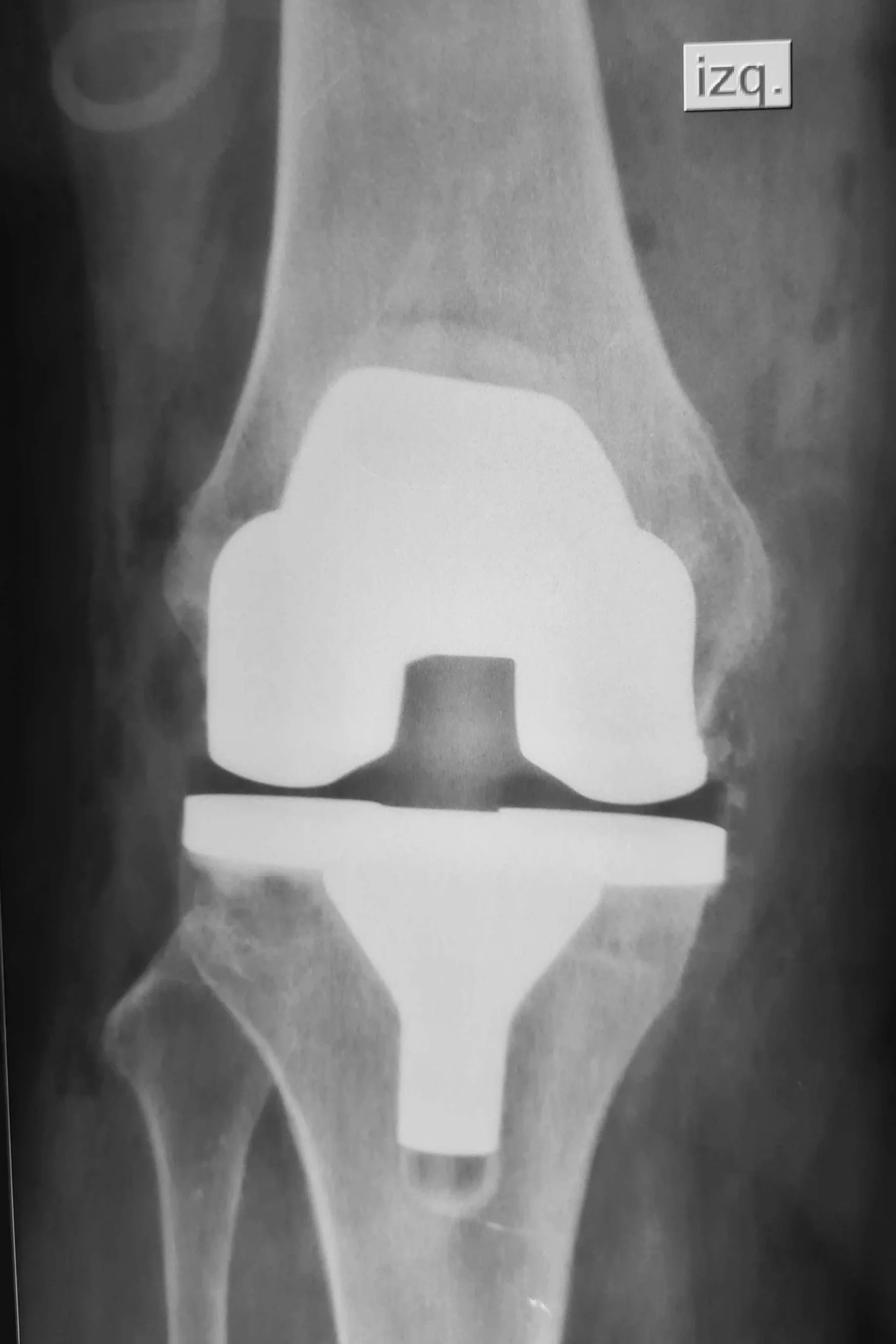 Radiografía de una articulación de la rodilla mostrando huesos y cartílagos en escala de grises.