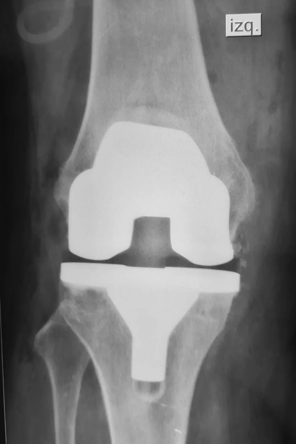 Radiografía de una prótesis total de rodilla