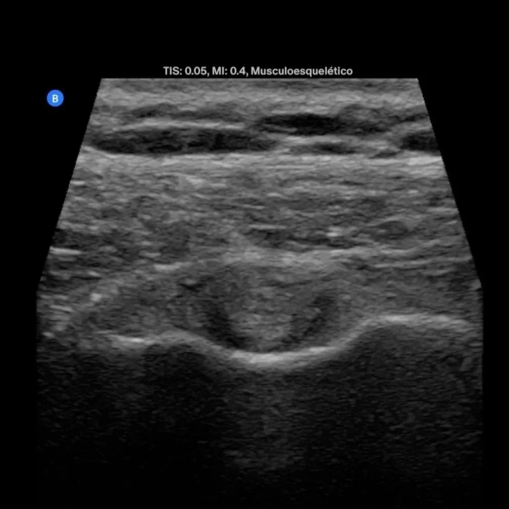 Una ecografía musculo esqueletica mostrando un tendón y un músculo.