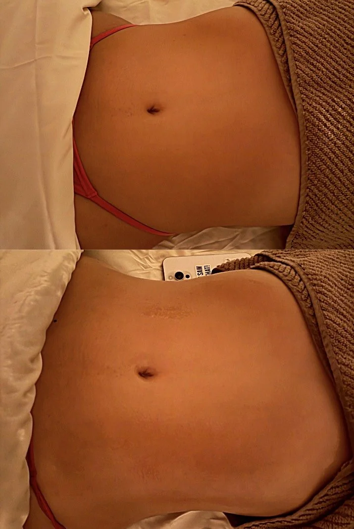 Comparison of a person's abdomen before and after applying a skincare product, showing reduction in stretch marks.