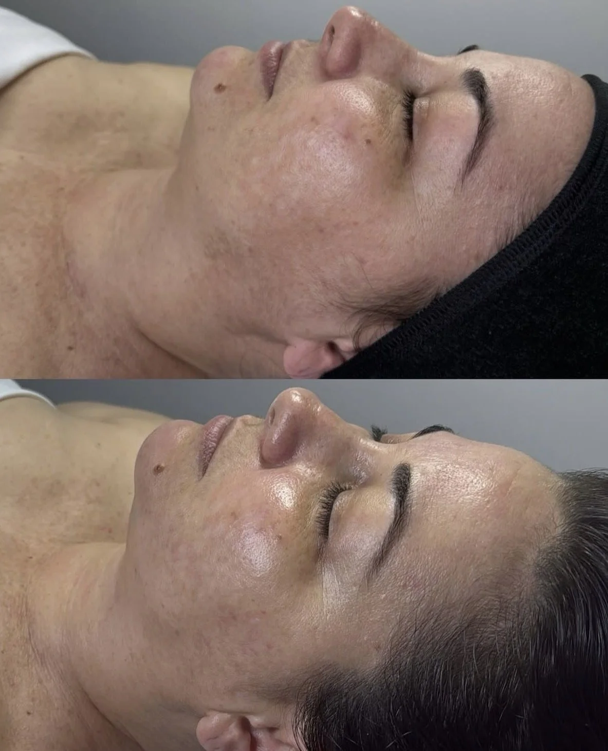 Comparison of a woman's face before and after a skincare treatment, showing improved skin texture and glow.