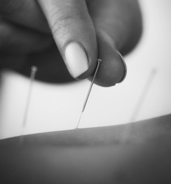 Dry Needling, Dr Annique Smith, Experienced Caring Chiropractor, Kelmscott, Seville Grove, Gosnells, Pain releief