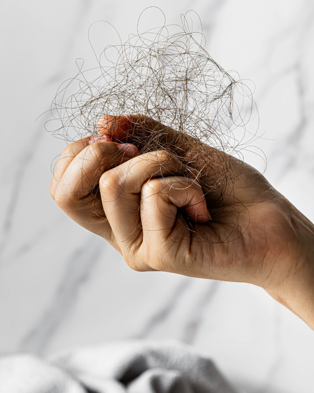 Scalp micropigmentation for transplant scar camouflage on scalp