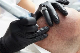 Hair loss solution using non surgical scalp micropigmentation treatment