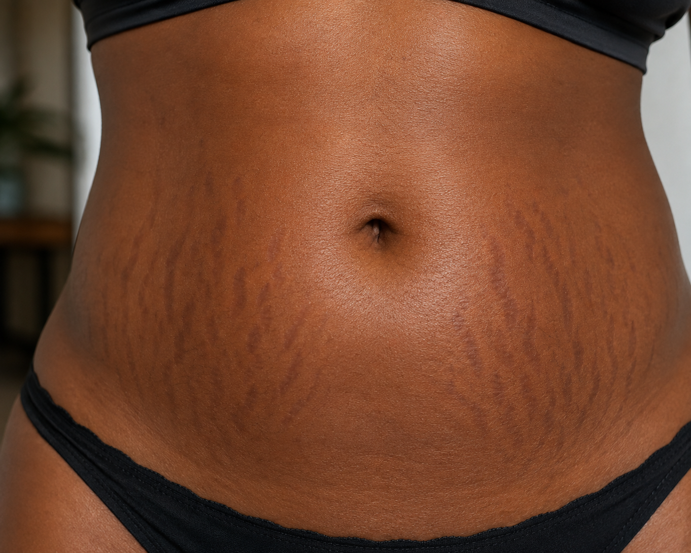 Stretch Mark Revision