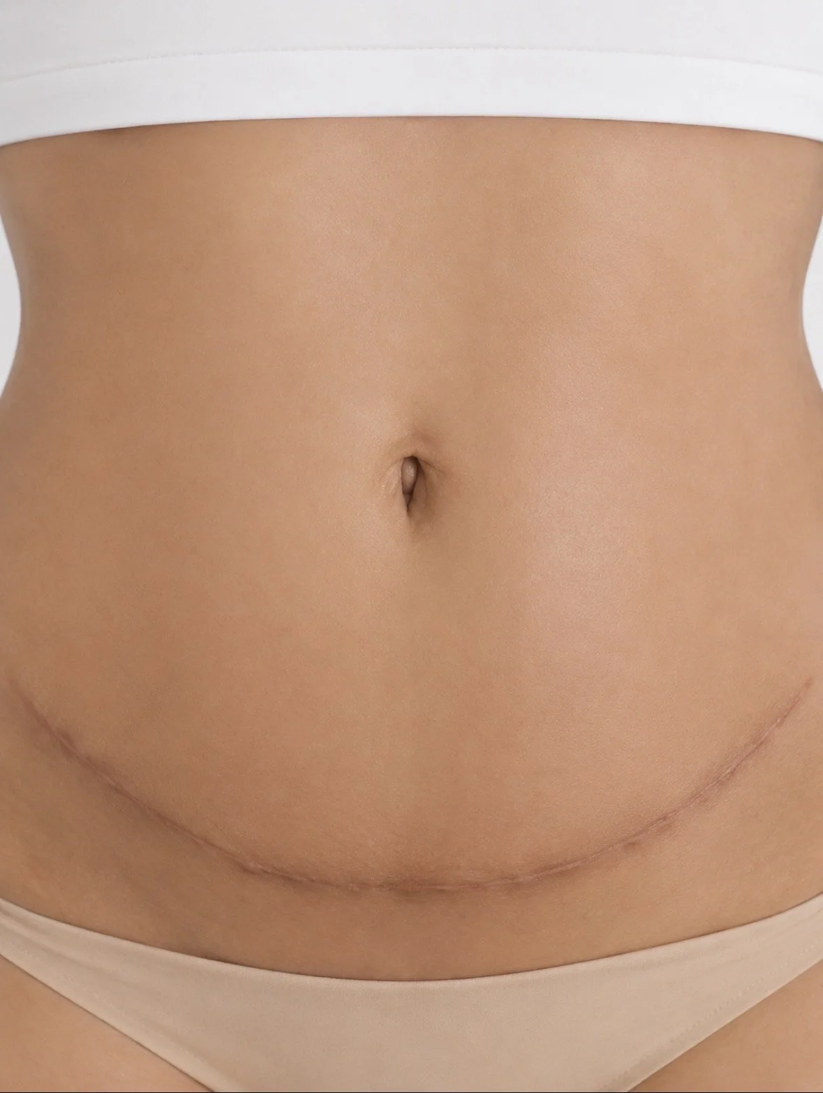 Scar Revision