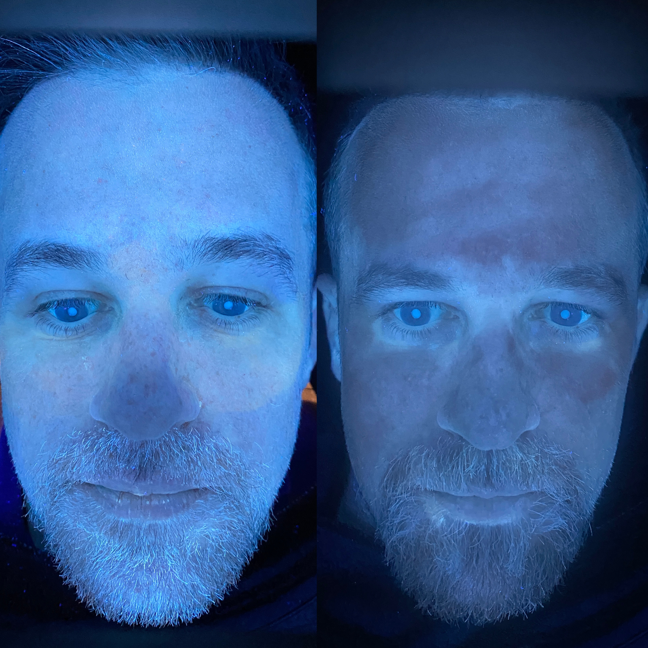 Mans skin under a skin analysis LED light