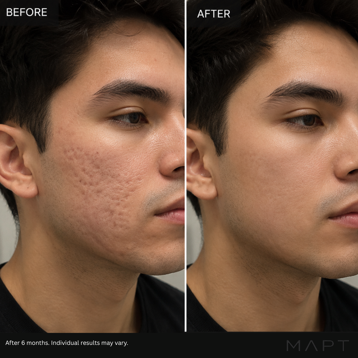 Acne Scars in Men: What Actually Works?