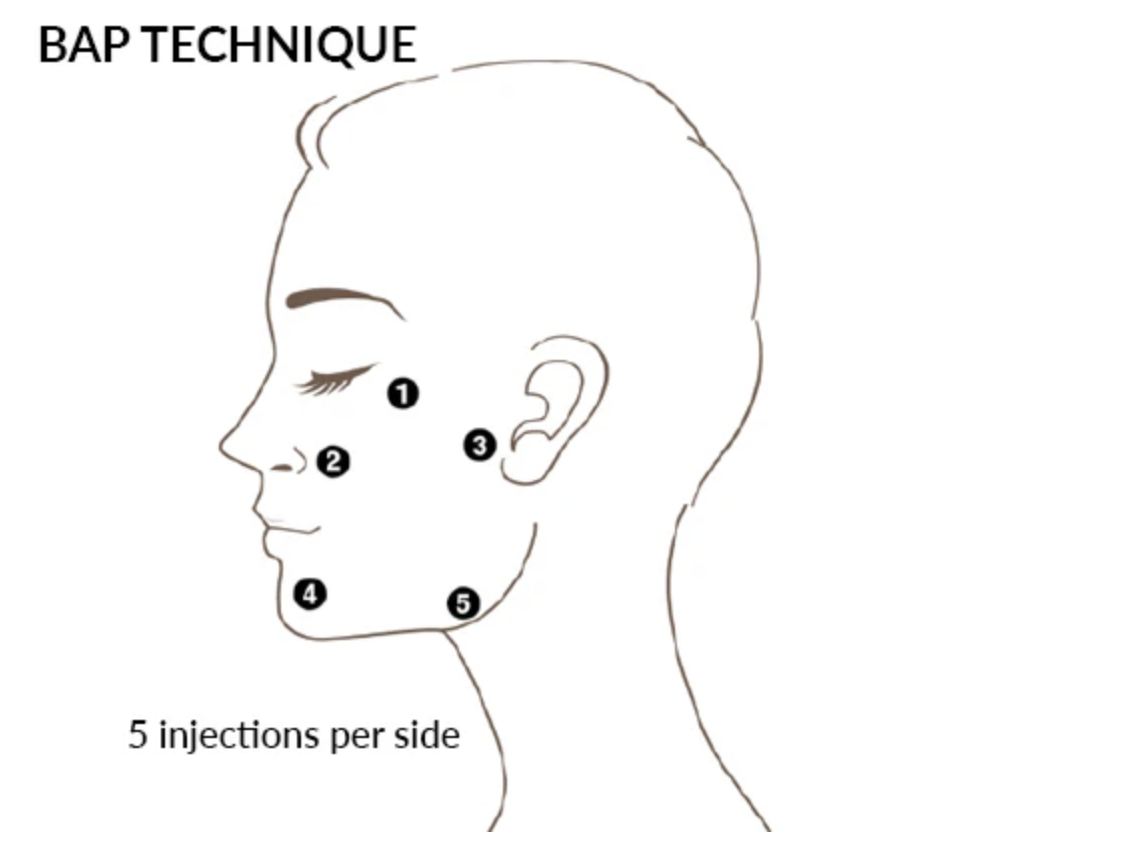 BAP technique diagram for skinboosters