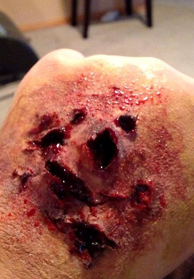 A close-up of a severely injured, bleeding knee with a layered, open wound, exhibiting torn skin and blood.