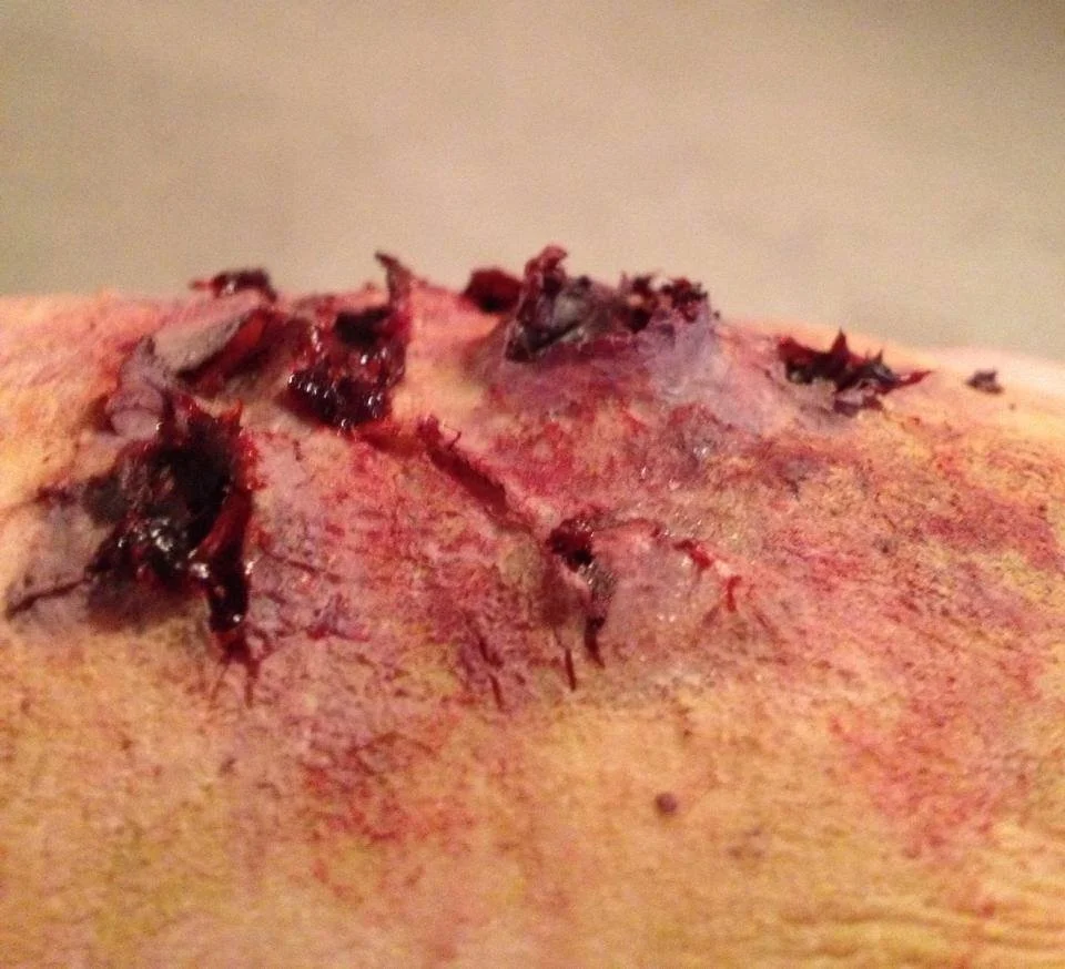 Close-up of a wound with bleeding and raw tissue visible.