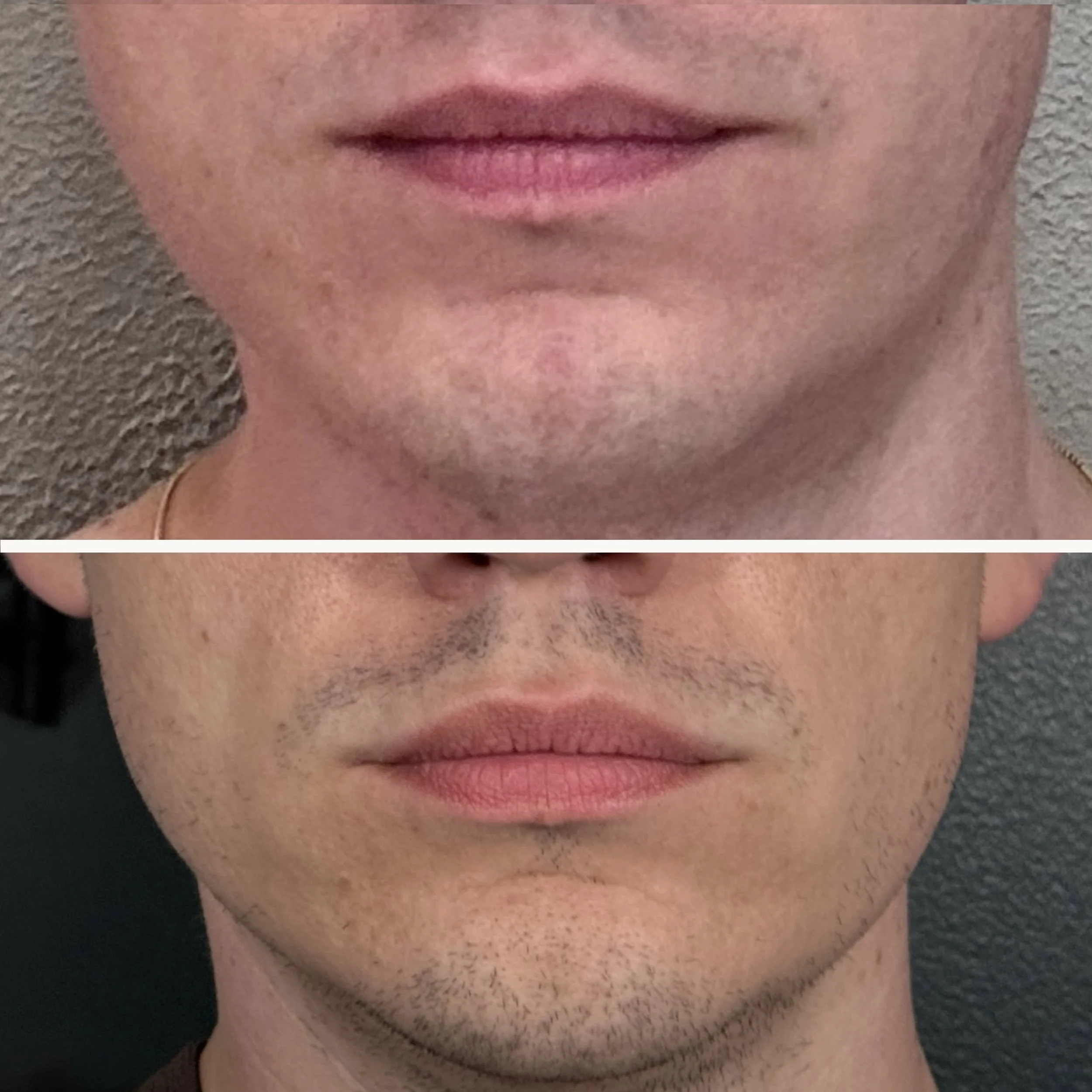 Lower Lip Flip and Lower Face Tox (before/after)