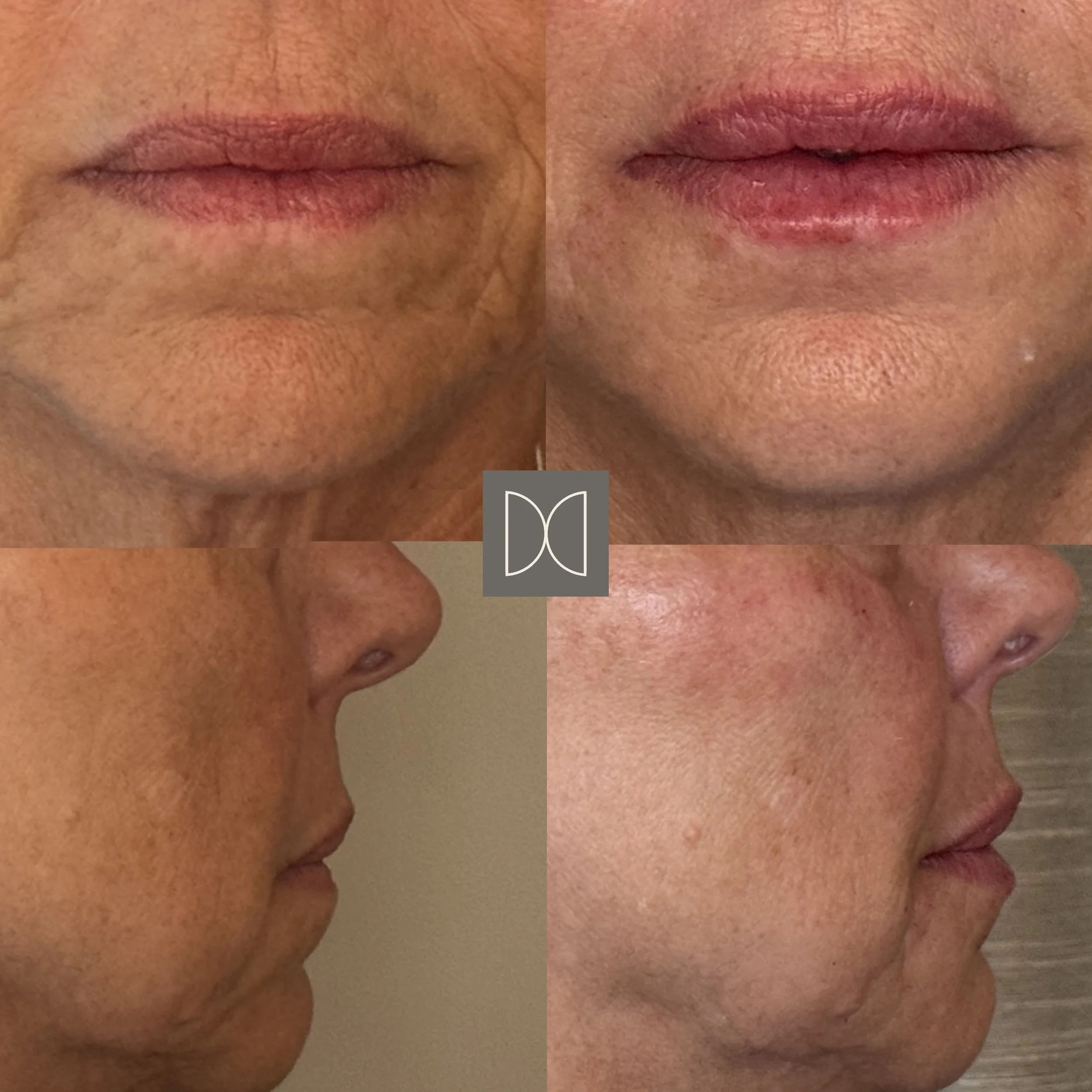 Lip & Cheek Enhancement