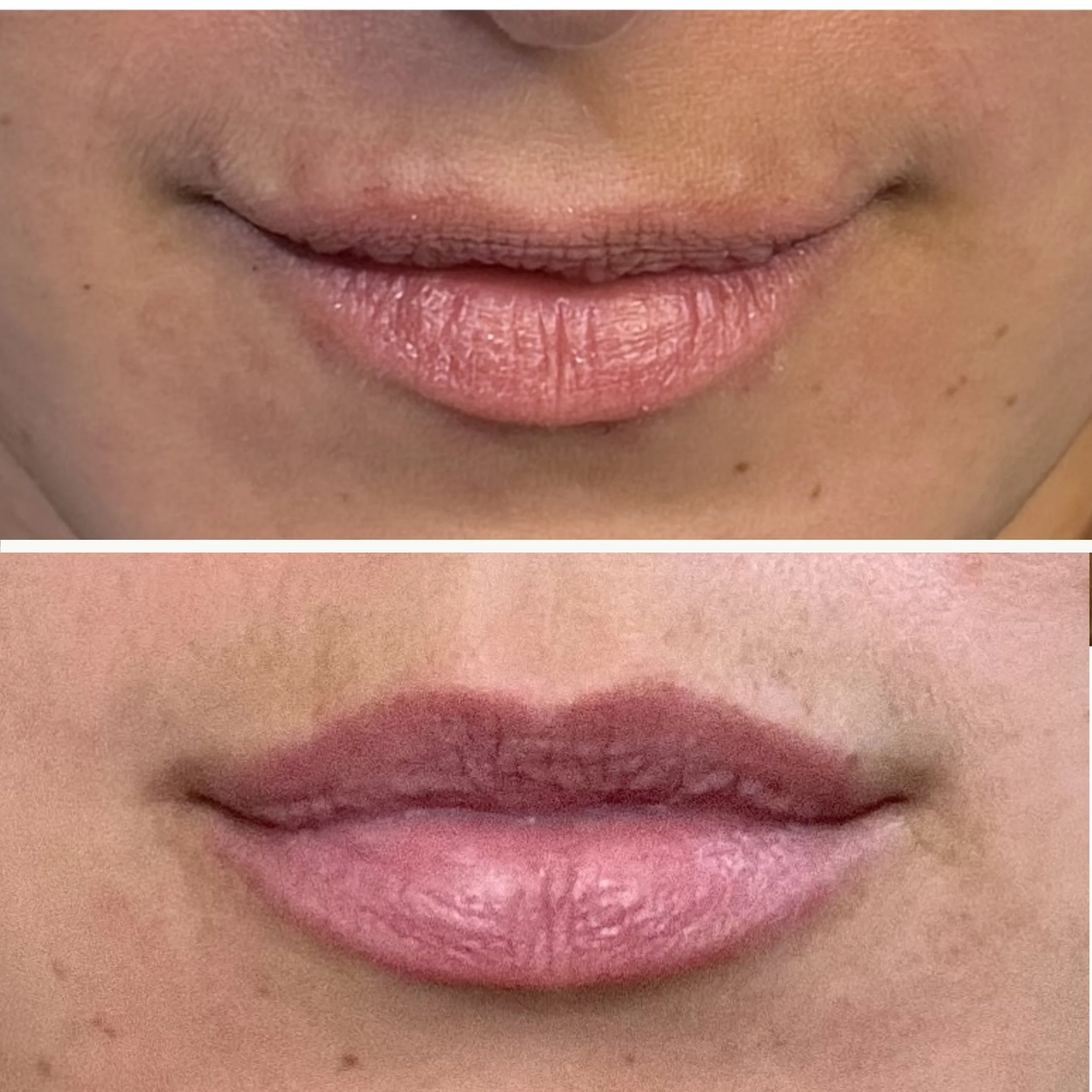 Lip Flip with Tox (before/after)