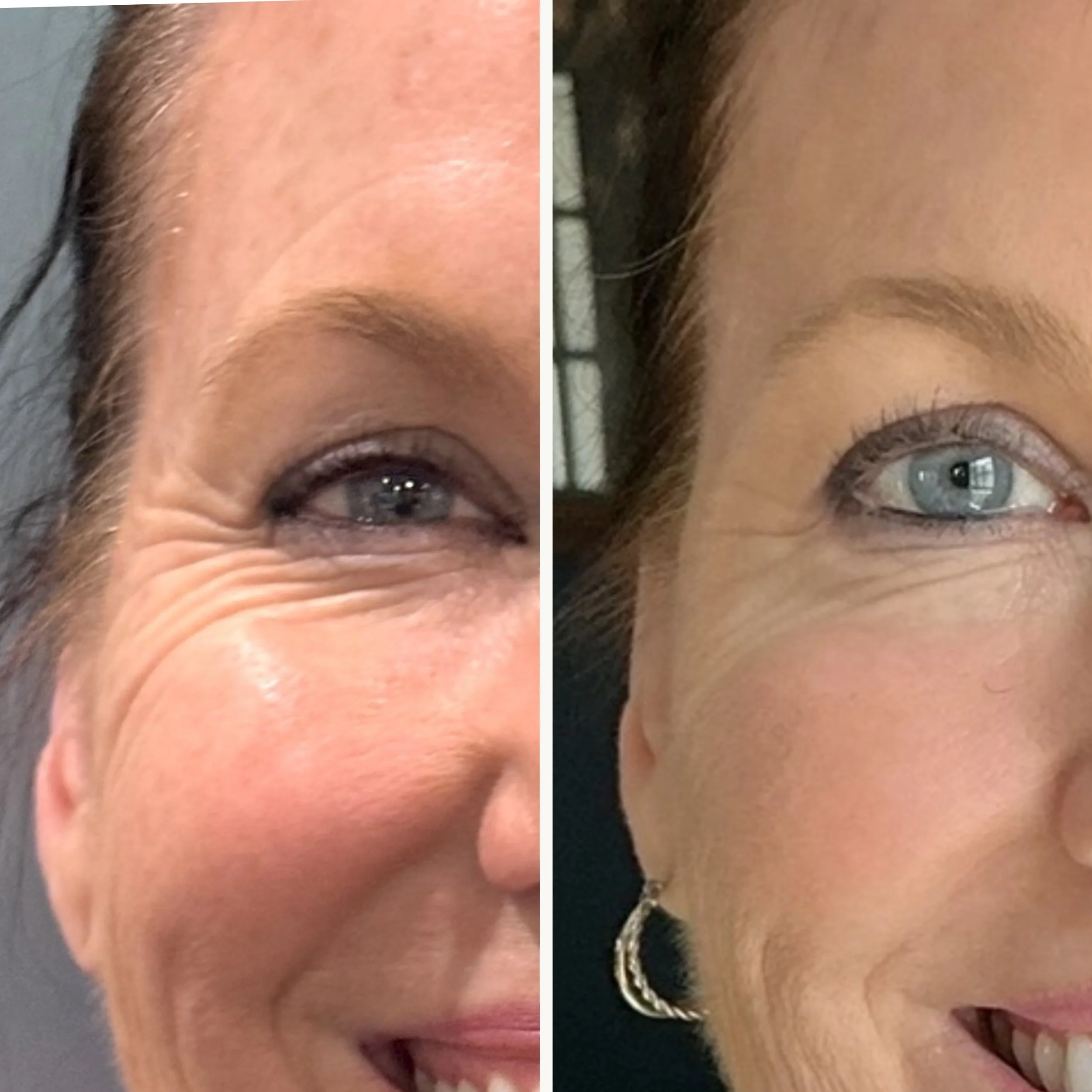 Crow's Feet and Eyebrow Lift with Tox (before/after)