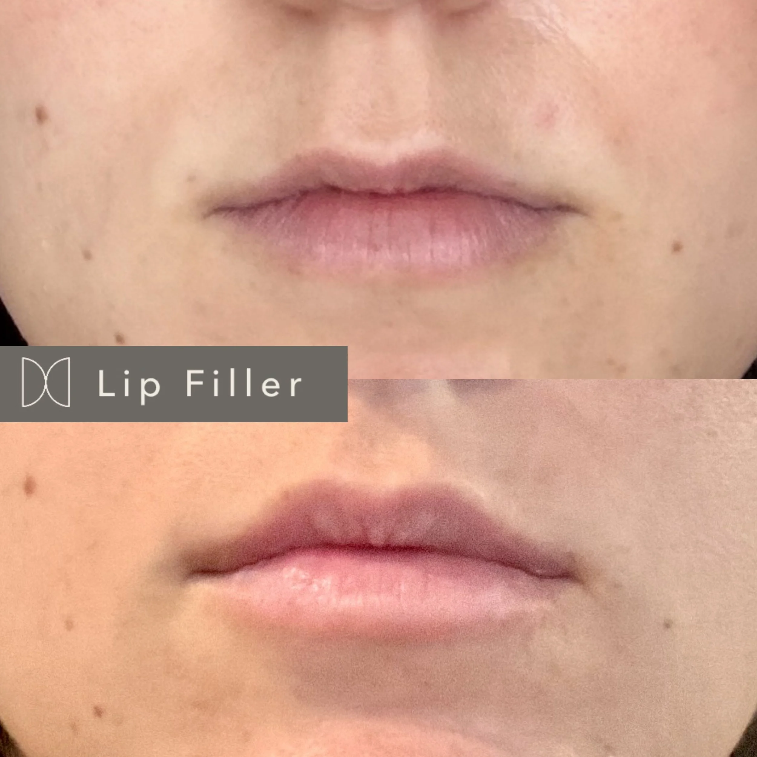 Lip Filler (before/after)