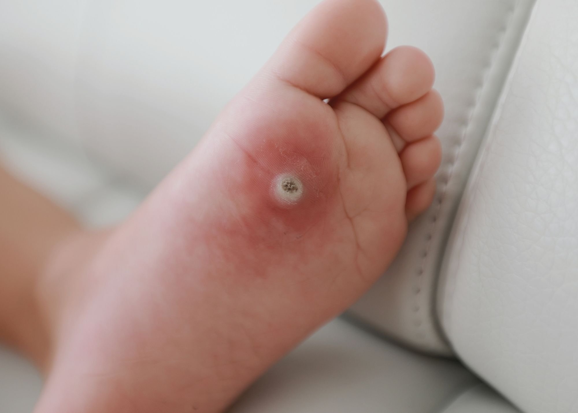 Close-up of a person's foot with a small black and white hair follicle or mole near the heel, placed against a white background.