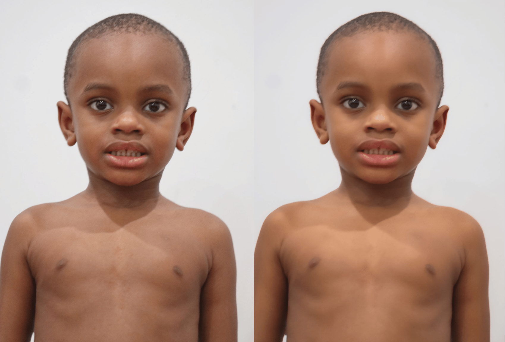 Side-by-side comparison of a young boy with short hair, shirtless, standing against a plain white background. In the left photo, he appears to be slightly anxious or uncomfortable, showing a nervous expression. In the right photo, he looks more relax