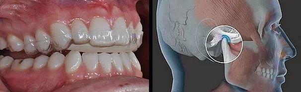 Quando è indicato il BITE?