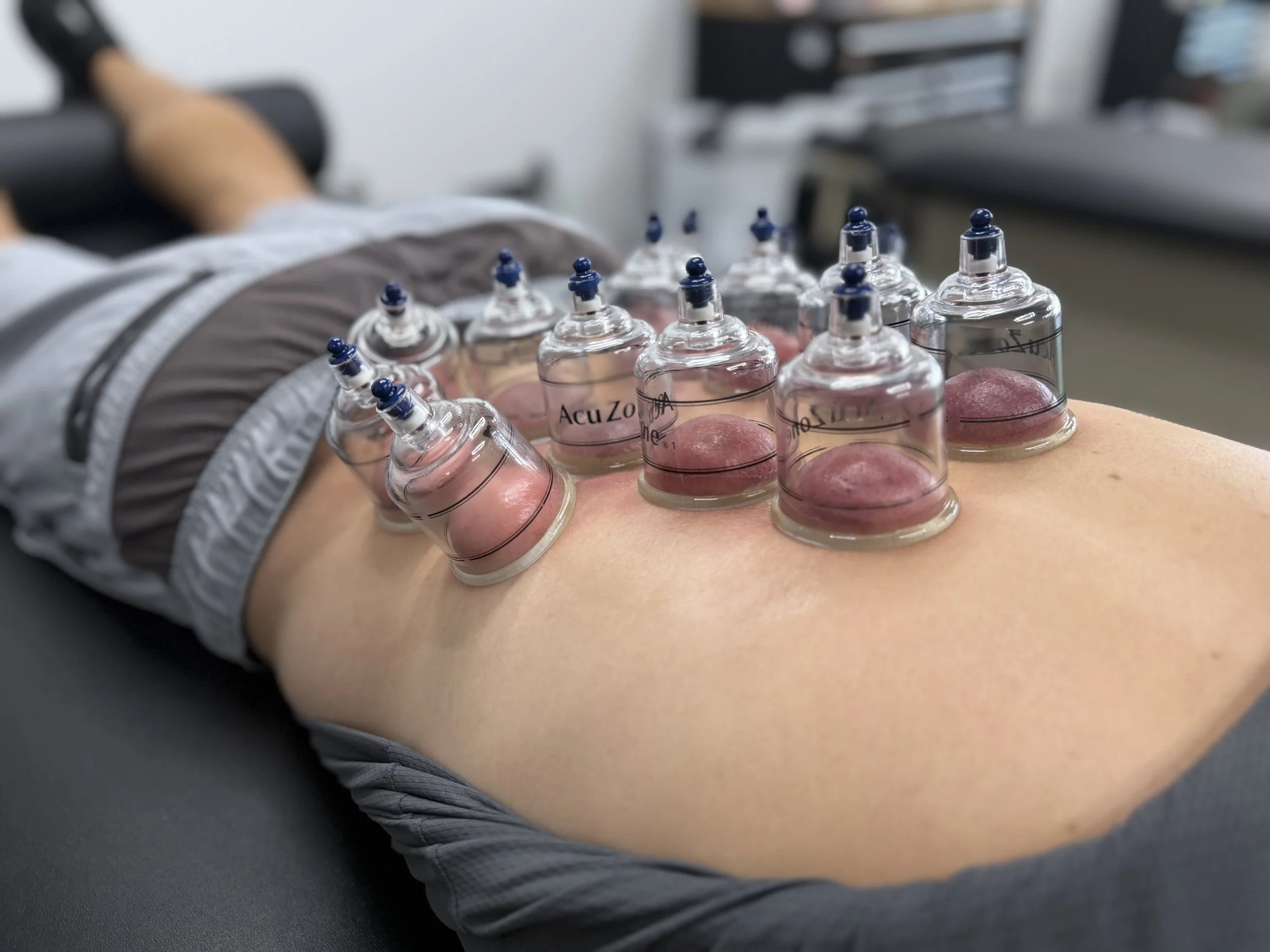 A person's arm resting on a surface, with multiple cupping therapy cups placed on the forearm, indicating a massage or therapeutic treatment.
