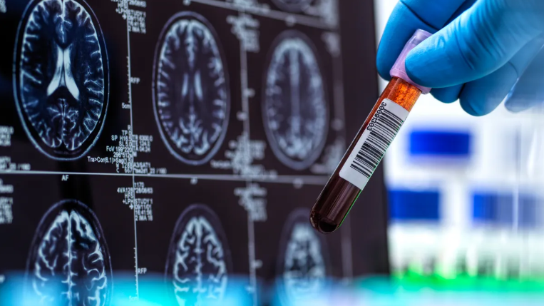 Alzheimer's drug pipeline broadens beyond amyloid as researchers pursue new targets