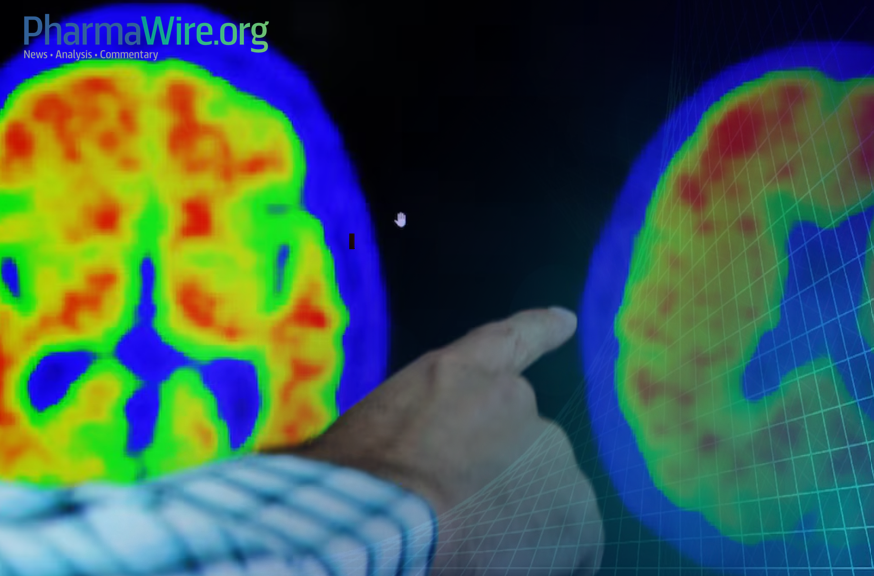 Biogen's anti-tau Alzheimer's drug shows mixed but encouraging results in mid-stage trial