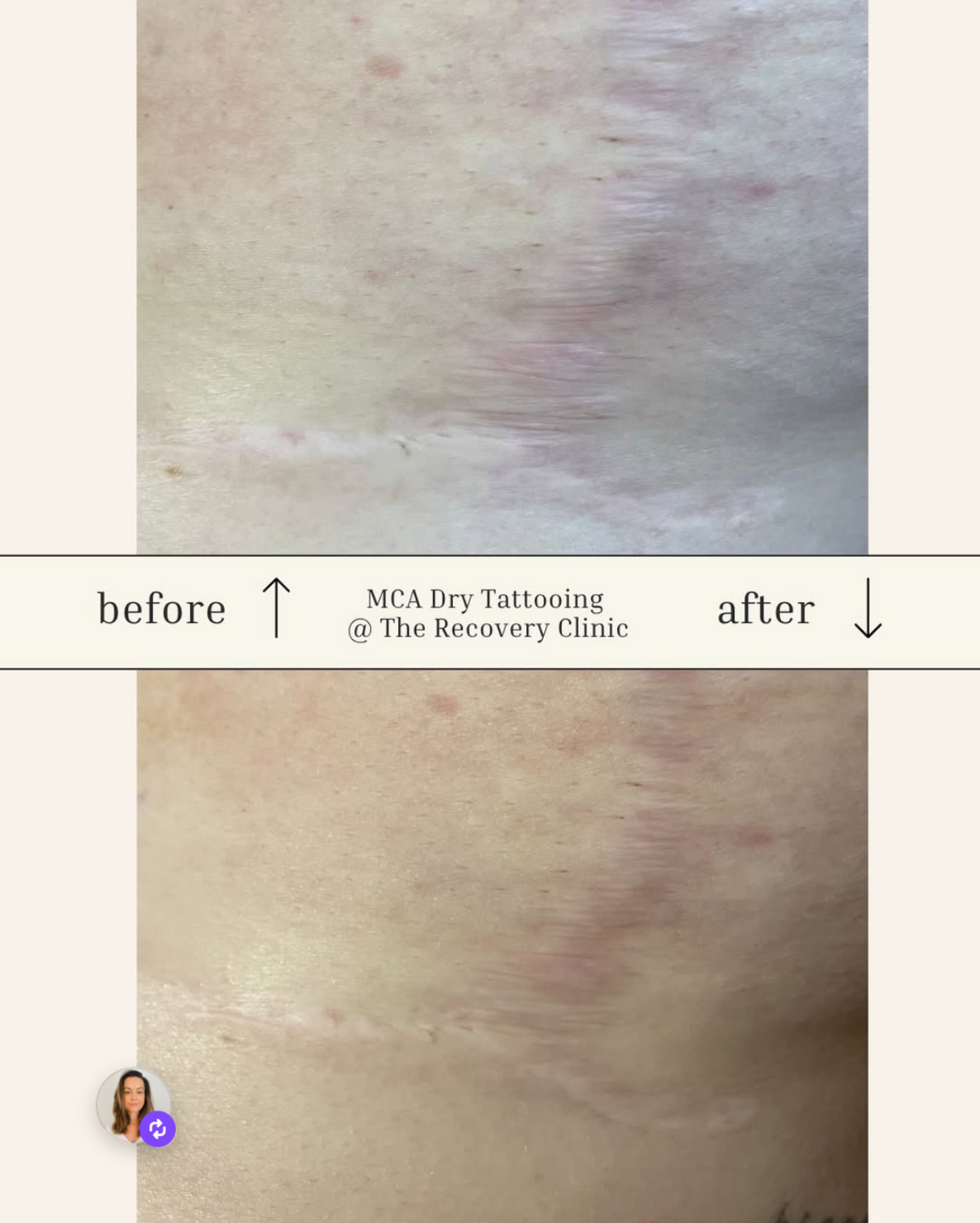 Comparison of skin before and after MCA dry tattooing at The Recovery Clinic, showing healing and reduced redness.