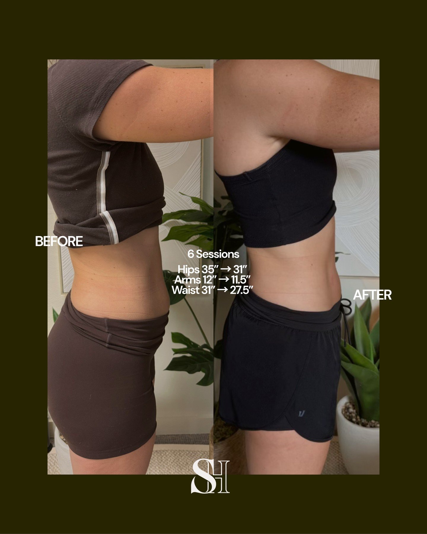 6 sessions. Major results. 👏

Hips: 35&rdquo; &rarr; 31&rdquo;
Arms: 12&rdquo; &rarr; 11.5&rdquo;
Waist: 31&rdquo; &rarr; 27.5&rdquo;

A closer look at what consistency + a personalized Sculpt Haus treatment plan can do. Stronger, more defined, more