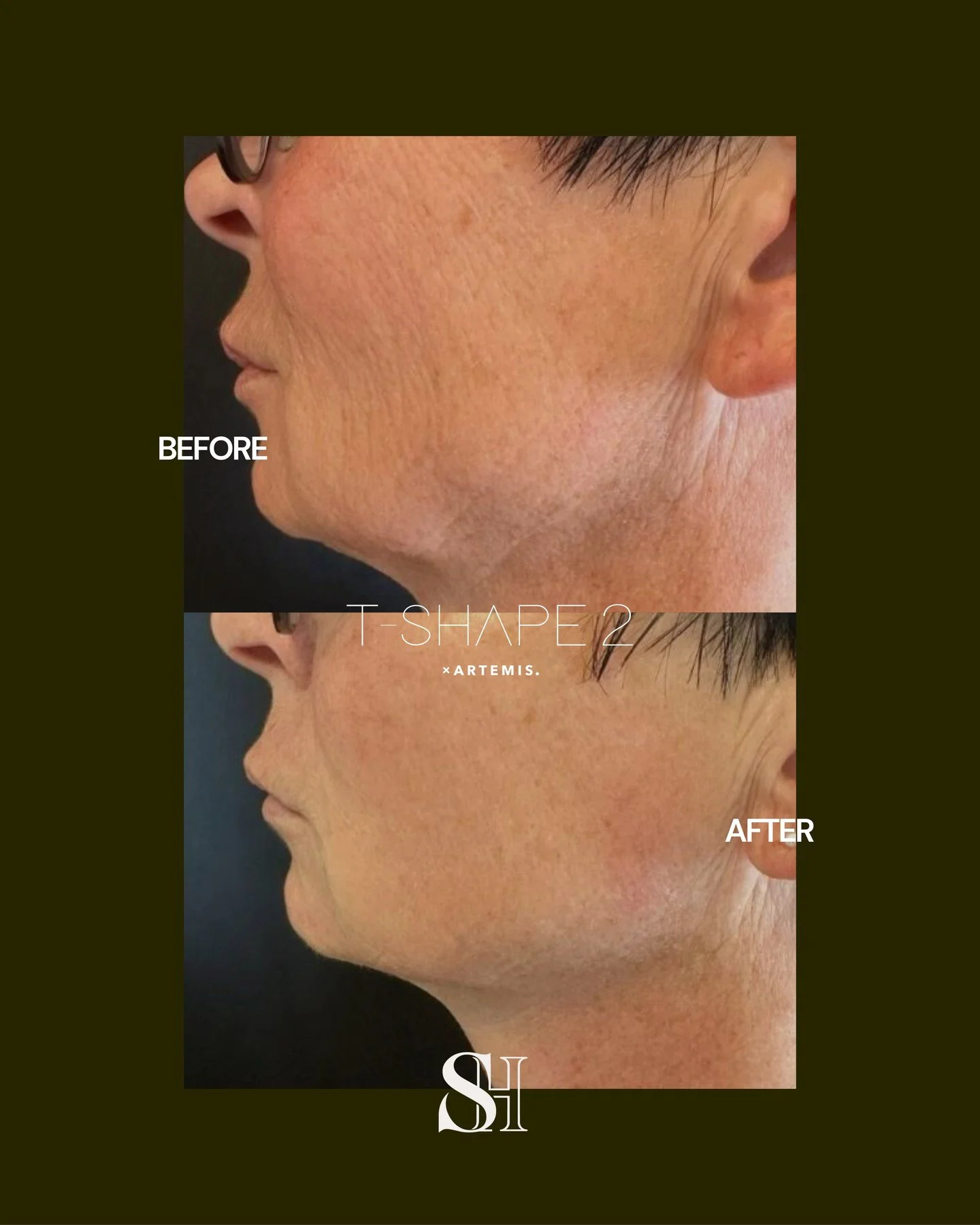 A more sculpted, lifted look. No surgery required.

Meet T-Shape 2, a non-invasive treatment designed to improve skin firmness, smooth texture, and enhance definition along the jawline and neck.

Think firmer, smoother, more contoured skin&mdash;with