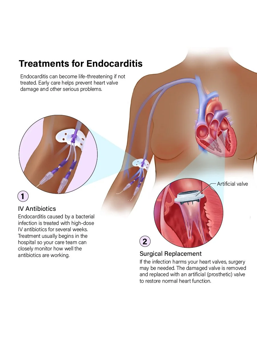 Diagram explaining treatments for endocarditis, including IV antibiotics and surgical replacement of damaged heart valves.