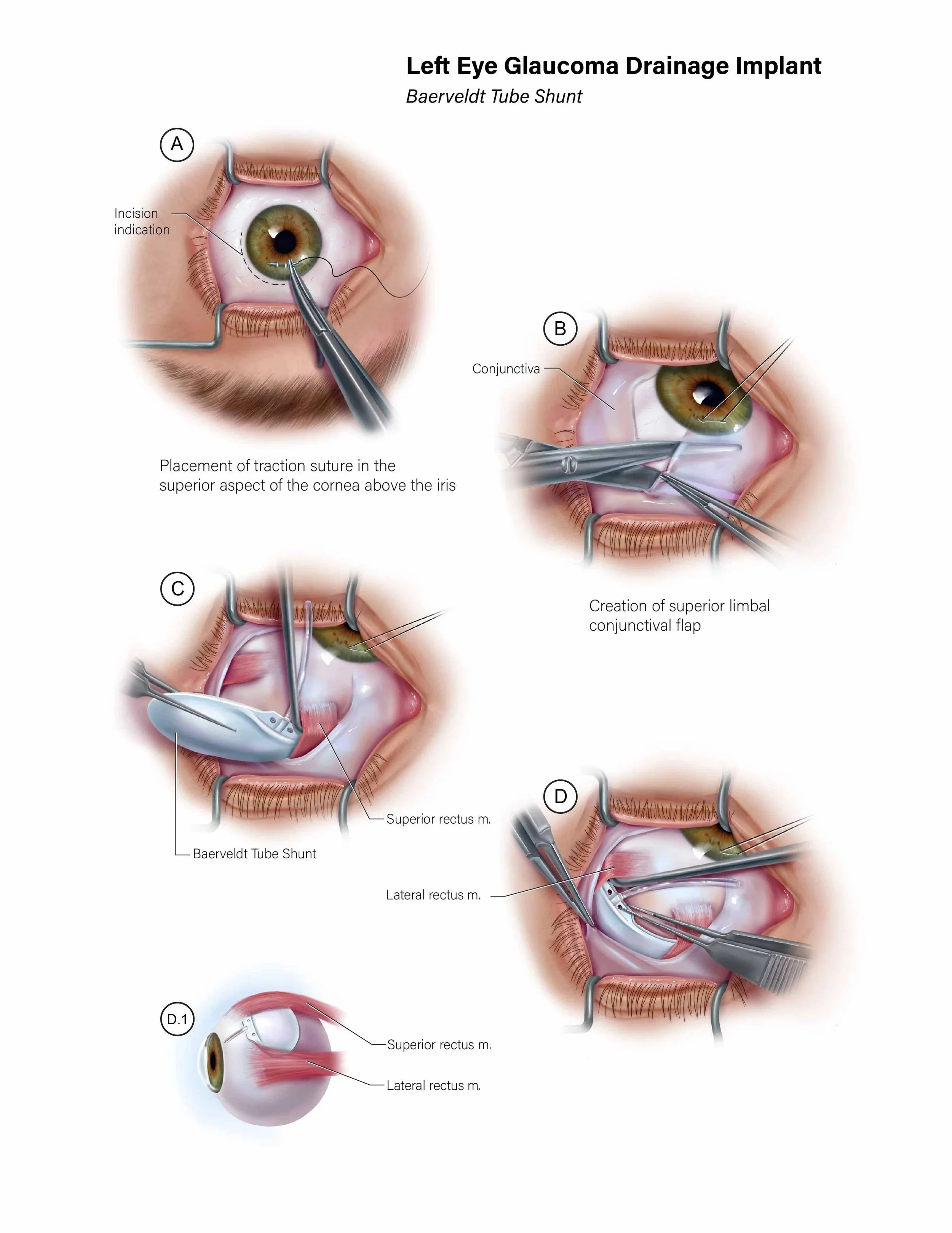 Plate I of a three-part series illustrating the step-by-step surgical insertion of a glaucoma drainage implant for use by medical residents.