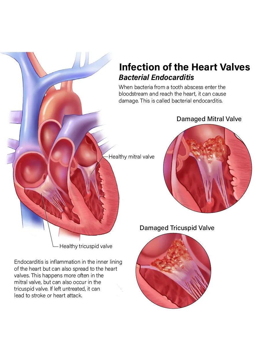 Diagram showing healthy and damaged heart valves with information about bacterial endocarditis caused by bacteria from a tooth abscess entering the bloodstream and affecting heart valves.