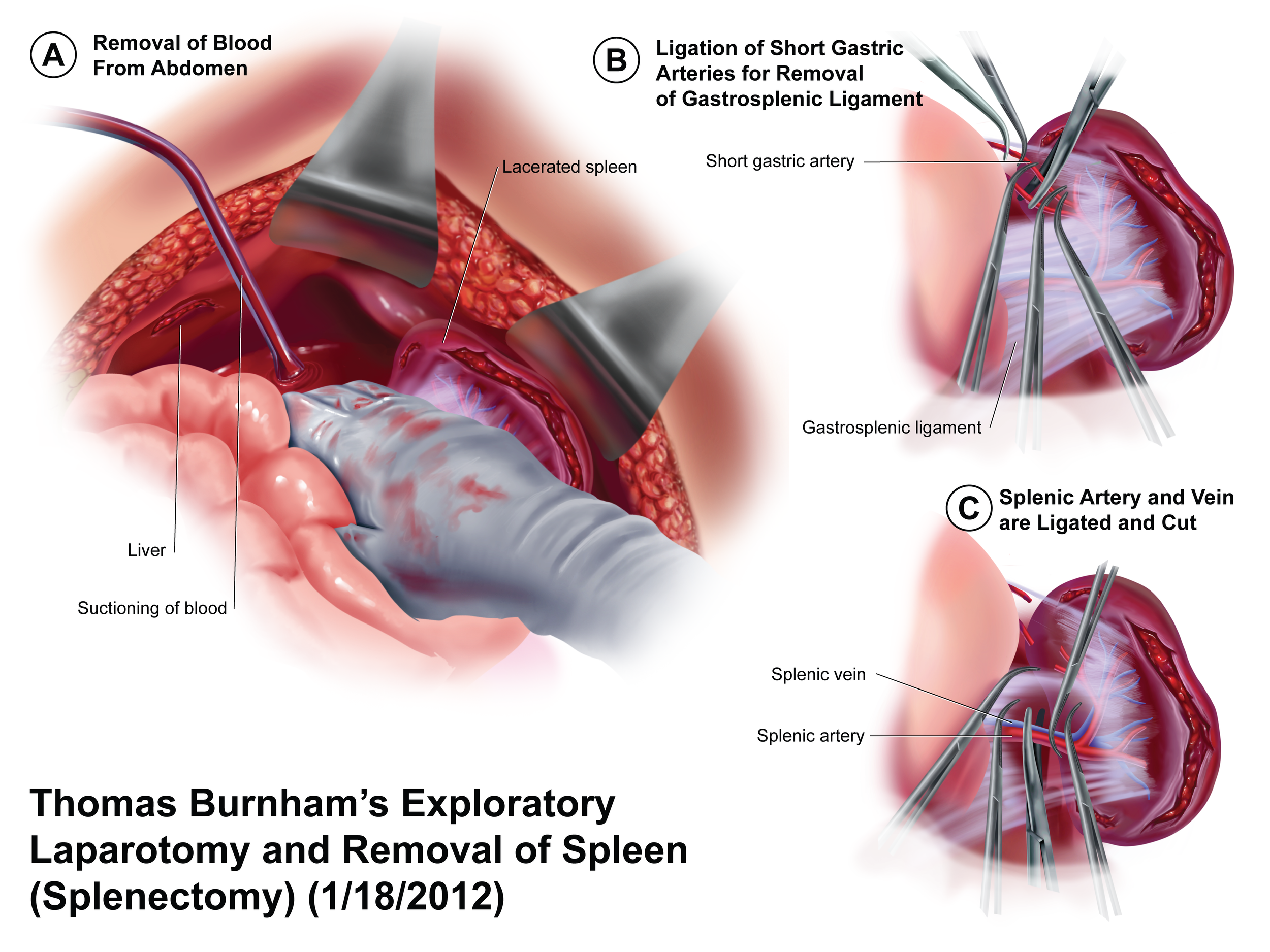 Diagram illustrating the procedure for removal of the spleen, including steps like blood removal from the abdomen, ligation of short gastric arteries and veins, and cutting of splenic artery and vein.