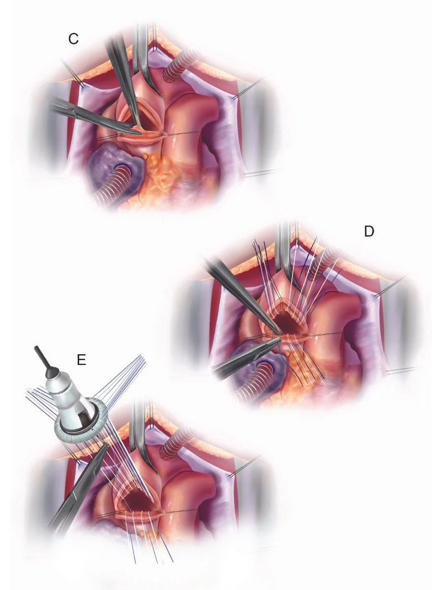 Surgical illustrations outlining steps involved in the replacement of the aorta valve.