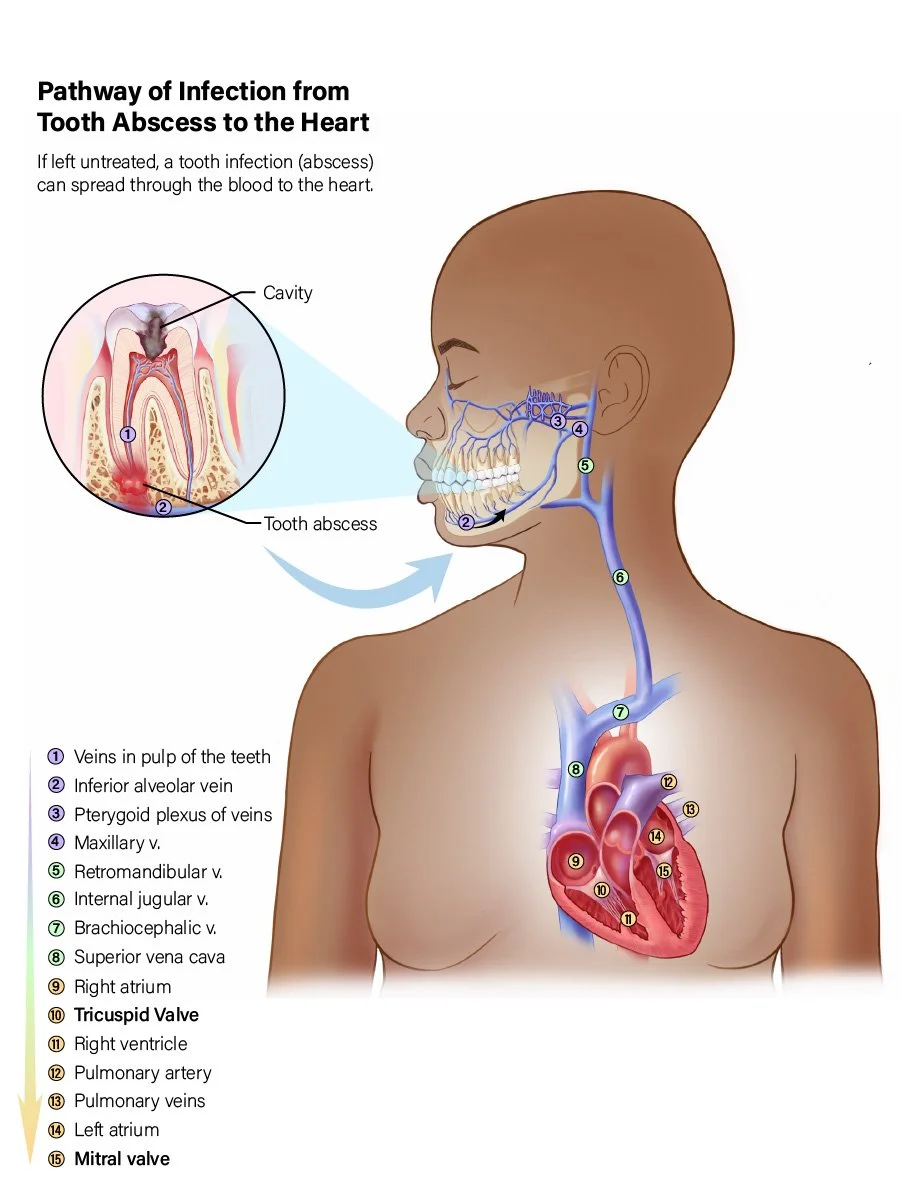 Diagram showing the pathway of infection from tooth abscess to the heart, highlighting veins and heart chambers, with labels for teeth, veins, and heart valves.