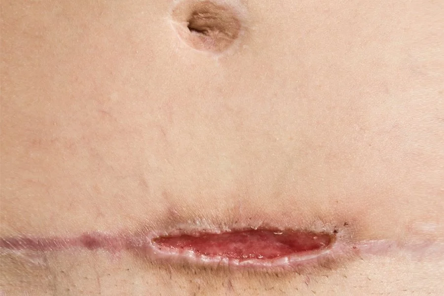 Wound Dehiscence