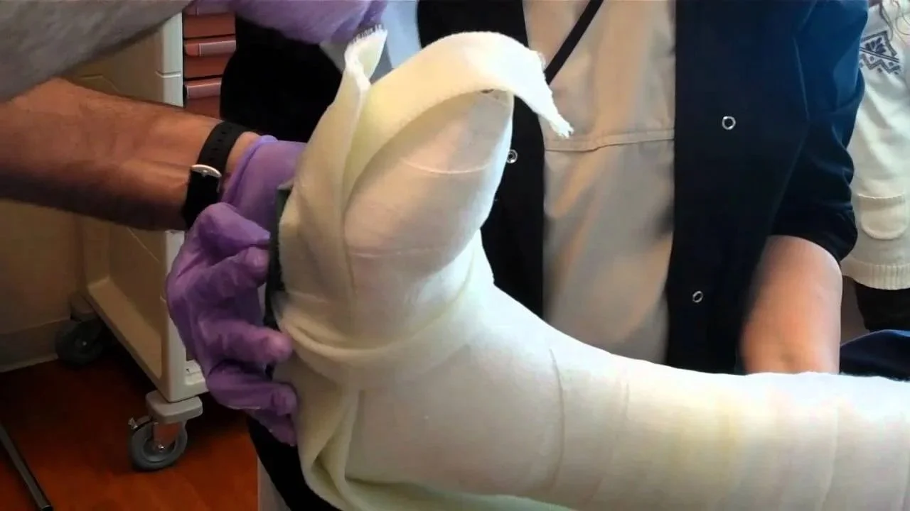 Total Contact Cast
