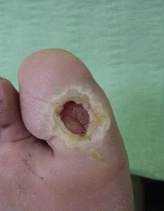 Diabetic Foot Ulcer