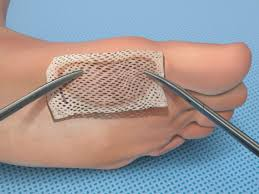 Bioengineered Skin Substitutes