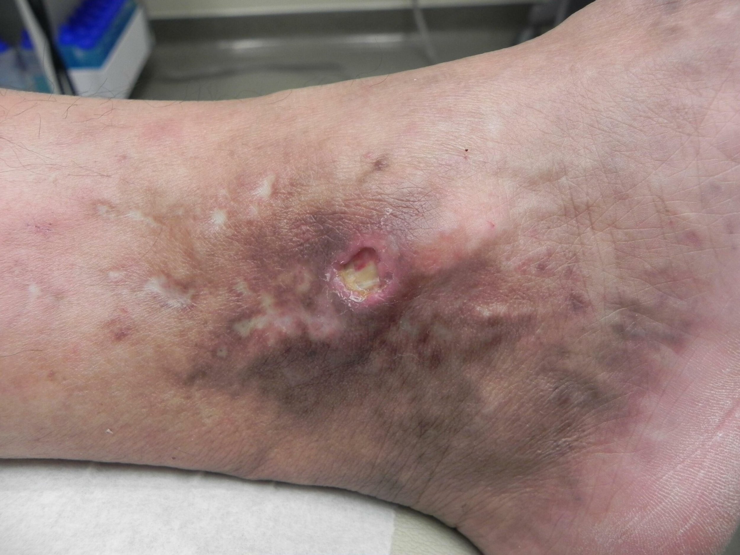 Venous Stasis Ulcer