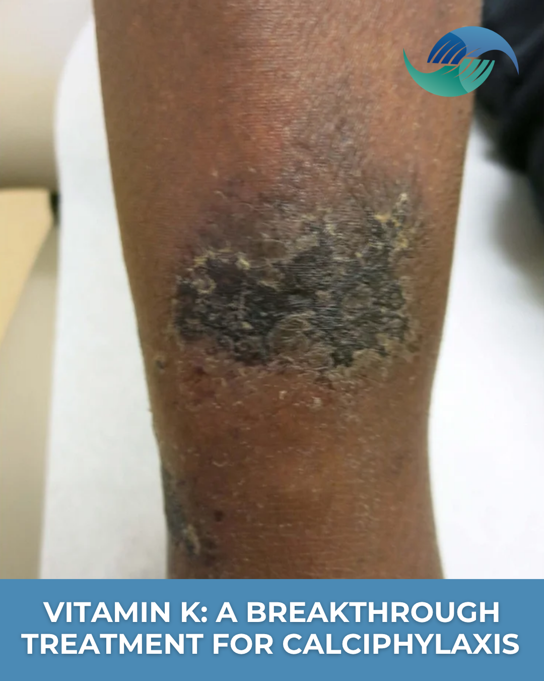 Vitamin K: A Breakthrough Treatment for Calciphylaxis