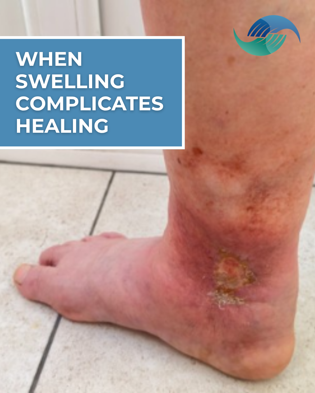 When Swelling Complicates Healing: Wound Care for Patients with Lymphedema&nbsp;
