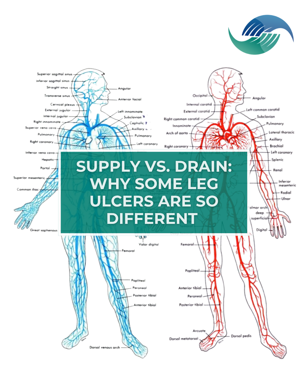 Supply vs. Drain: Why Some Leg Ulcers Are So Different&nbsp;