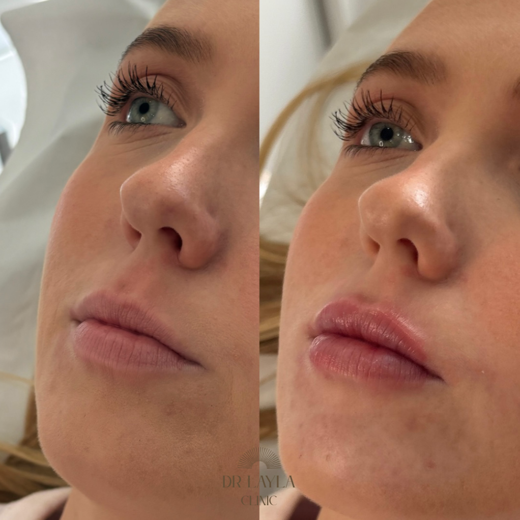 Natural lip filler result by Dr Layla Kadhim, Dr Layla Clinic in Marylebone. Aesthetic Doctor specialising in natural results.